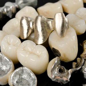 石川でパラジウム等歯科用金属の買い取りならエチュード