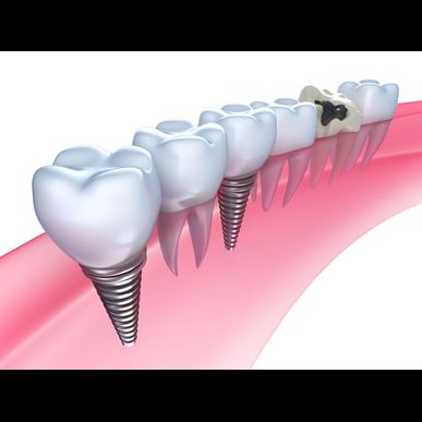 石川でプラチナの歯科用金属の買い取りなら当社にお任せください
