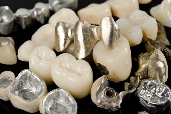 歯科用金属のパラジウム